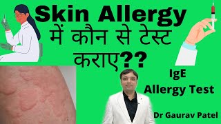 Test in skin allergy in Hindi  स्किन ऐलर्जी में कौन से रिपोर्ट कराए SIgE amp Allergy test [upl. by Marena]