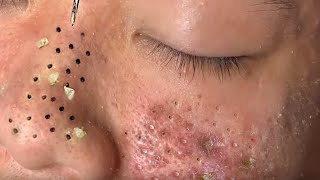 Blackhead Removal With Sac Dep Spa 100074254 [upl. by Baiel]