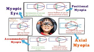 Myopia  Introduction and Etiology within 3 min 15 [upl. by Anar]