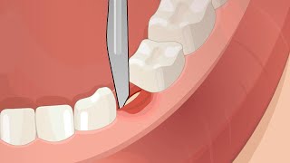 Dental Surgery Operation Root Canal Implant Anesthesia [upl. by Farrand]