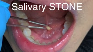 Salivary Stone or Sialolithiasis [upl. by Michael]