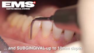 Piezon Instrument PS sub and supragingival scaling amp root debridement [upl. by Lorak]