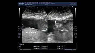 Ultrasound Video showing Anencephaly  a neural tube defect [upl. by Vincent400]