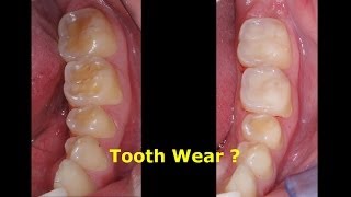 Tooth Wear Attrition Erosion Abrasion CEREC Omnicam and Enamic to the Rescue [upl. by Delos330]