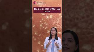 Ice Pick Scars Treatment  Ice Pick Scars TCA Cross  Acne Scar Treatment in Noida  Skinlogics [upl. by Cirad]