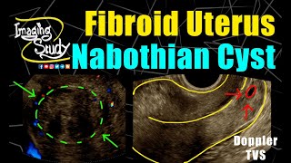 What Are Ovarian Cysts  When Should You Remove Them  TheFibroidDoc  Dr Cheruba Prabakar [upl. by Alyson]