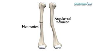 How are NonUnion amp Malunion of Fractures managed [upl. by Nalorac]