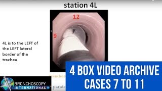 Bronchoscopy EBUS TBNA  4 Box Video Archive cases 7 to 11 [upl. by Zephaniah]