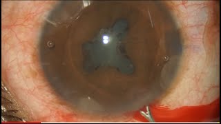 Phaco in Complicated Cataract  Dr Ramakrishna Tadanki [upl. by Melly]