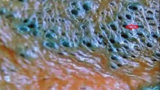 Solar Comedones and Blackheads  Blackhead King [upl. by Nosnevets]