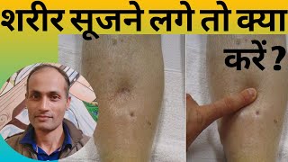 Apocynum Cannabinum Homeopathy। Homeopathic Medicine for Dropsical swelling of Body [upl. by Kellyn]