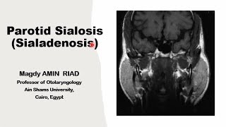 Parotid Sialosis Salivary Sialoadenosis [upl. by Christean]