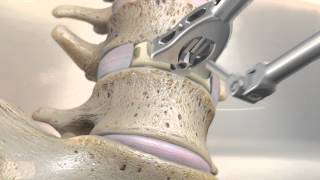 STALIF M™ MIDLINE II Surgical Technique Animation  Anterior Lumbar Interbody Fusion [upl. by Keram]