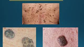 Skin cancer education [upl. by Jerrold997]