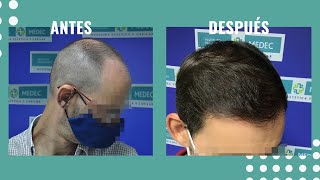 🙋‍‍ CASO REAL Injerto Capilar antes y después  3581 UFS  Resultados increíbles 👏‍‍ [upl. by Jennings]