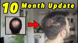 10 Month 2nd Hair Transplant Update  4000 GRAFTS FUE  HAIR IS GROWING  SMP [upl. by Hewett]