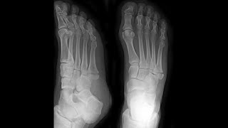 5th Metatarsal Base Fracture Foot [upl. by Cesaria499]