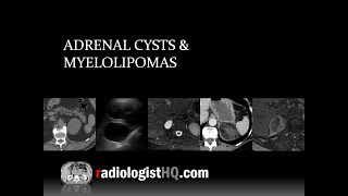 Abdomen Kidney evidence of an adenoma mass of the left adrenal gland3 of 5 [upl. by Enomar905]