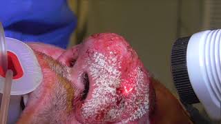 Rhinophyma Removal Incredible Results [upl. by Ab]