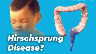 Hirschsprung Disease Colitis and Fecal Incontinence [upl. by Sirovart476]