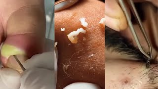 Unleashing Pimple Popper The Ultimate Satisfaction [upl. by Tedman9]