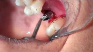 Cementation on implant crown [upl. by Eletnahs]