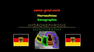 Sonographie  Harnaufstau [upl. by Haskins]