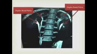 Congenital Anomaly Ureter Duplex and Duplex Renal Pelvis [upl. by Keelin]