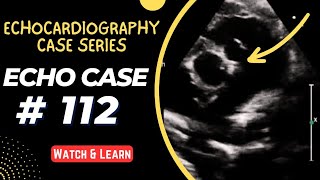 Echocardiography Case 112  Echocardiography For Beginners [upl. by Mccreary]