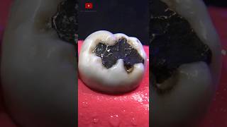 Restauración dental satisfying [upl. by Vashtia]