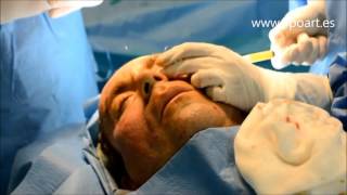 Lipofilling facial [upl. by Theis]