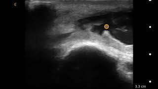 Image Interpretation Olecranon Bursitis [upl. by Nylasoj]