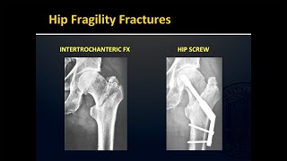 Fragility Fractures [upl. by Adihahs]