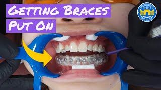 Process of Getting Braces [upl. by Yelha]