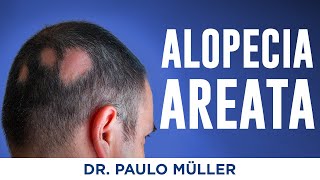 Alopecia Areata Falhas no Cabelo  Dr Paulo Müller Dermatologista [upl. by Vahe]