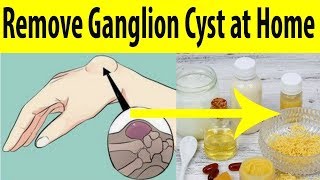 Home Remedies for Ganglion Cysts  Health Sutra [upl. by Ecnarrot]