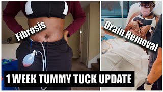 1 WEEK TUMMY TUCK UPDATE  Fibrosis  Drain Removal  Kenyatta Davis [upl. by Weinstock591]