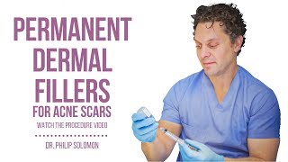 Permanent Dermal Fillers for Acne Scars  Dr Philip Solomon [upl. by Philis]