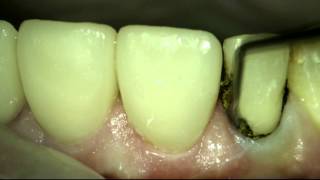 Gingival retraction [upl. by Kehoe]