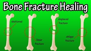 How Does A Bone Break Heal  Bone Fracture Healing Process [upl. by Doscher]