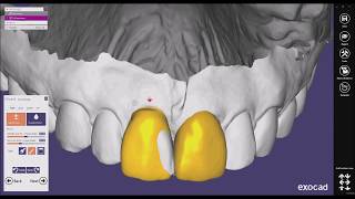 how to create mock up diagnostic wax up with exocad [upl. by Nolyat]