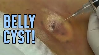 The Tummy Cyst  Busted [upl. by Eizzo]