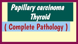 Papillary Carcinoma Of Thyroid [upl. by Anaitsirc]