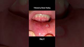 Aphthous Ulcer Time Lapse From Development to Healing Cold Sore [upl. by Irving]