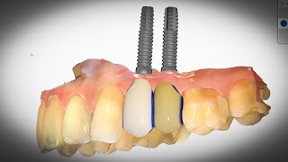 Dental Implants  AMAZING NEW 3D Technology [upl. by Aylad]