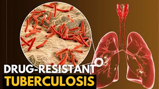 Tuberculosis Causes Signs and Symptoms Diagnosis and Treatment [upl. by Talich]