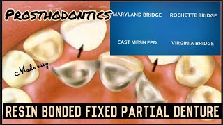 RESIN BONDED FIXED PARTIAL DENTURE II ROCHETTE MARYLAND CAST MESH VIRGINIA BRIDGES II FPD II easy [upl. by Nylanna886]