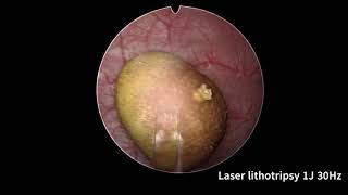 SLIM HOLEP 22Fr First stage of Surgery plus laser Cystolithotripsy [upl. by Liddy]