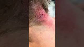 Boil popping boil cysts zit pimplepopping [upl. by Naoj]