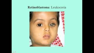 Retinoblastoma  CRASH Medical Review Series [upl. by Htebazie]